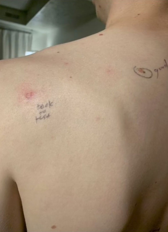 Woman Circled Her Husband’s Suspicious Moles Before A Dermatology Appointment, The Doctor Sent Him Back With Notes Written On Him