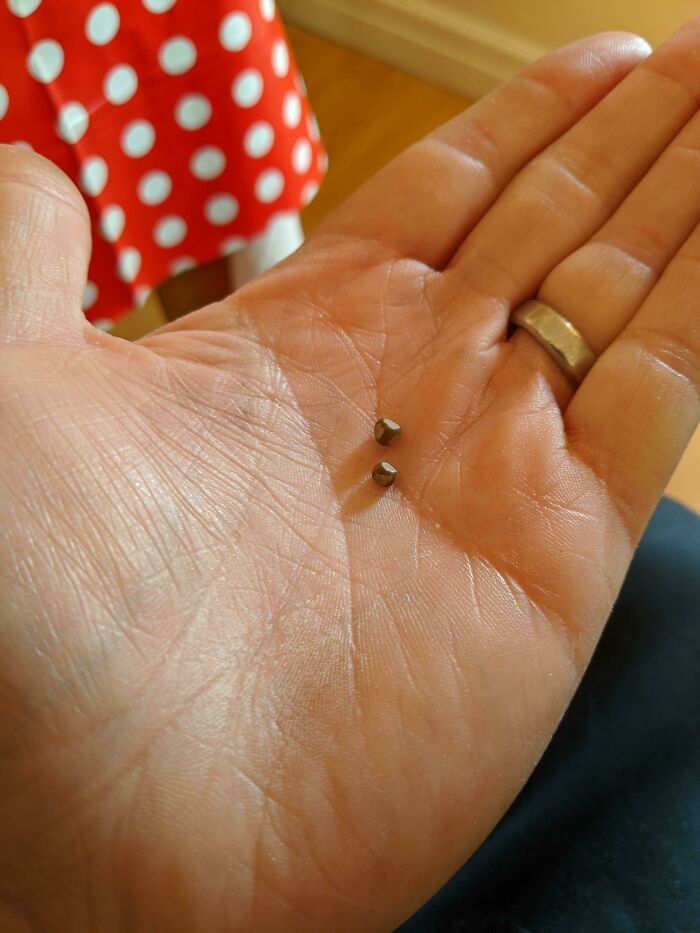 Two Kidney Stones I Passed Today. Hand For Scale