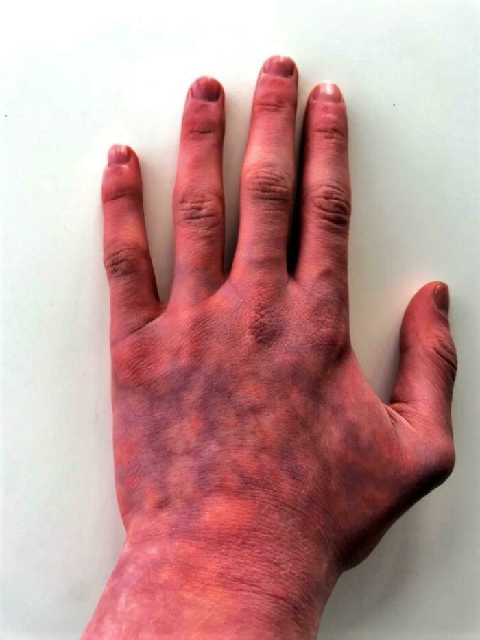 This Happens To My Hands At Cold Temperatures