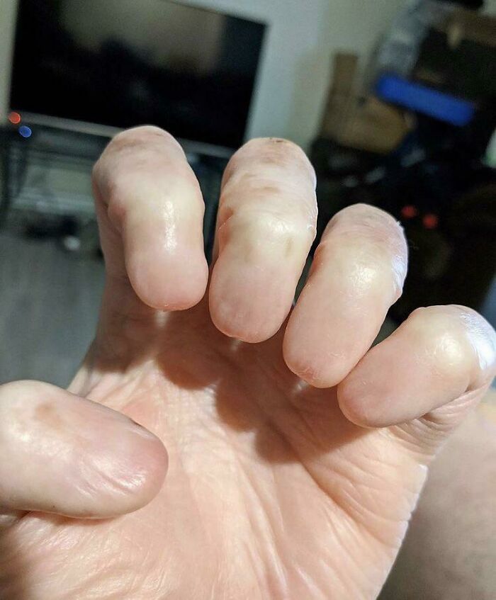 Dedos sin uñas
