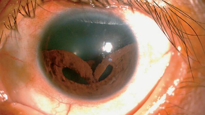 Una lesión ocular provoca la pérdida del iris de un hombre