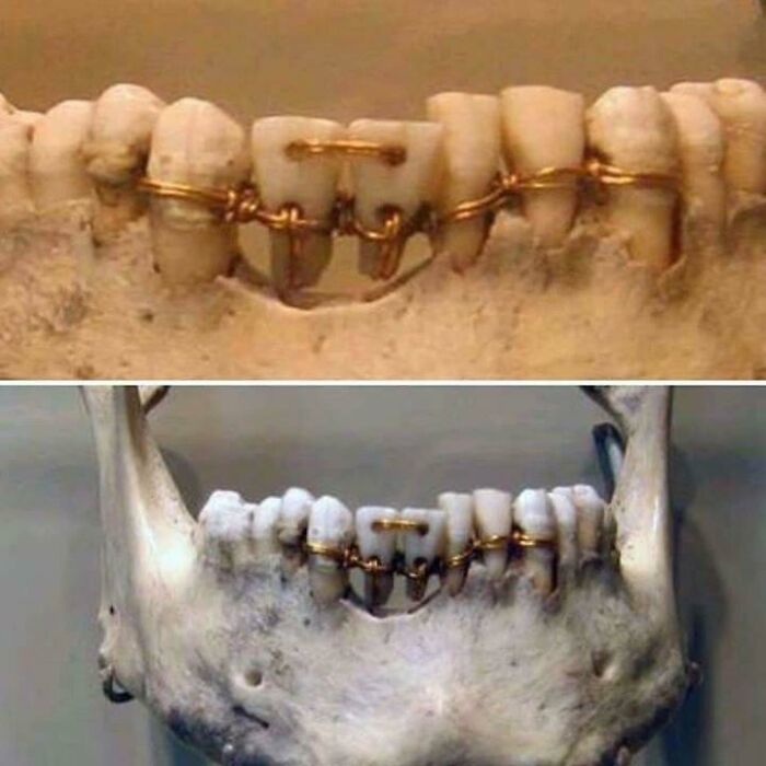 Dental Work Found On A 4,000 Year Old Mummy