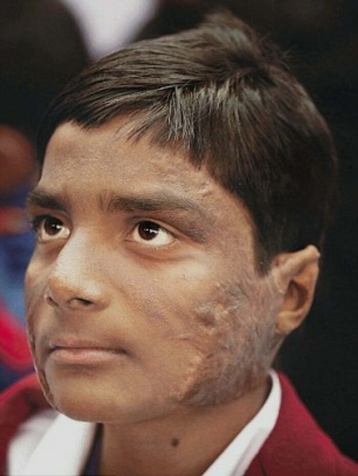 This Is The Smile Of Someone Who Stared Death In The Face. And Promptly Told It To Piss Off. Om Prakash, A 10 Year Old Kid From India, Saved 8 Children Out Of A Burning School Bus