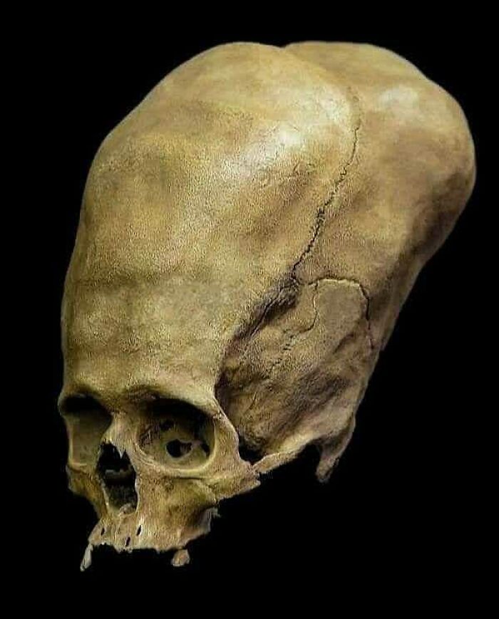 The Mystery Of The Paracas Elongated Skulls. During The 1920s, Peruvian Archaeologist Julio Tello Discovered A Series Of Tombs In Paracas, Peru