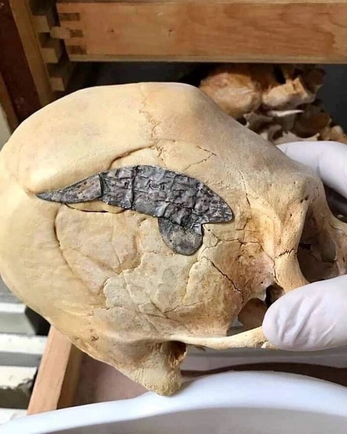 Este cráneo alargado con una placa de metal implantada de forma quirúrgica data de hace unos 2.000 años y fue encontrado en Perú. El hueso que rodea el implante está soldado firmemente al metal, lo cual indica que la cirugía fue todo un éxito