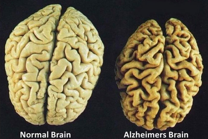 Normal Brain vs. Alzheimers Brain