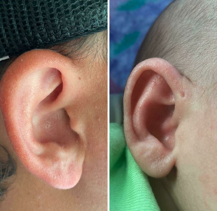 The Right Picture Is My Boyfriend's (23M) Ear And The Left Picture Is Our Daughter's Ear (7 weeks old). They Have The Same Small Indent That Looks Like Hole, On The Same Ear