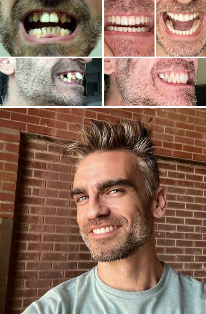 After A Lifetime Of Having Bad Teeth, I Decided To Do Something About It 2 Years Ago. Here's The Finished Product - I'm Finally All Done
