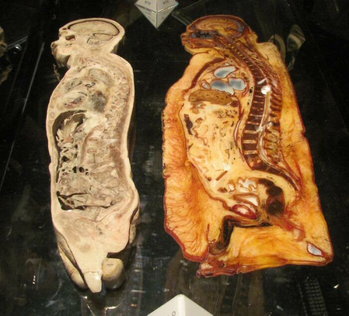 Vertical Bisection Of A Normal Human Cadaver vs. Morbidly Obese Cadaver