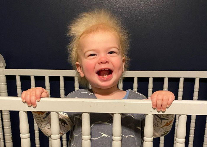 A este alegre niño se le diagnosticó el síndrome del cabello impeinable
