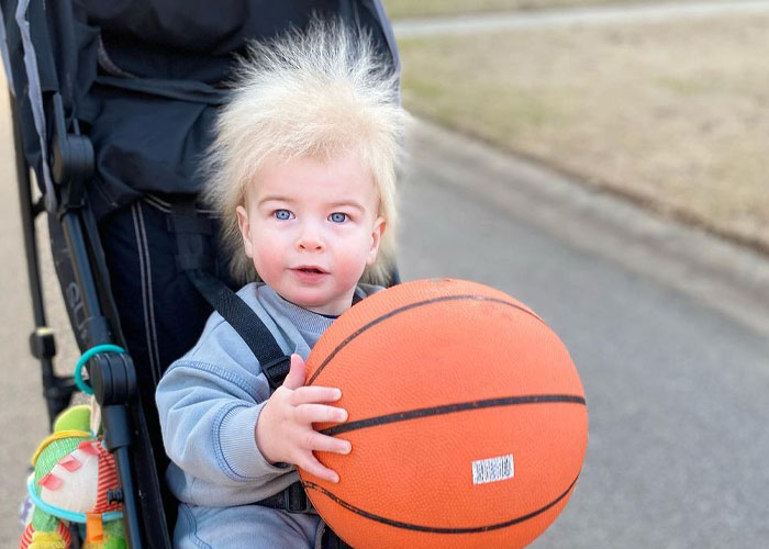 A este alegre niño se le diagnosticó el síndrome del cabello impeinable