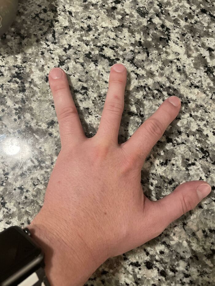 I Was Born With 4 Fingers On My Left Hand