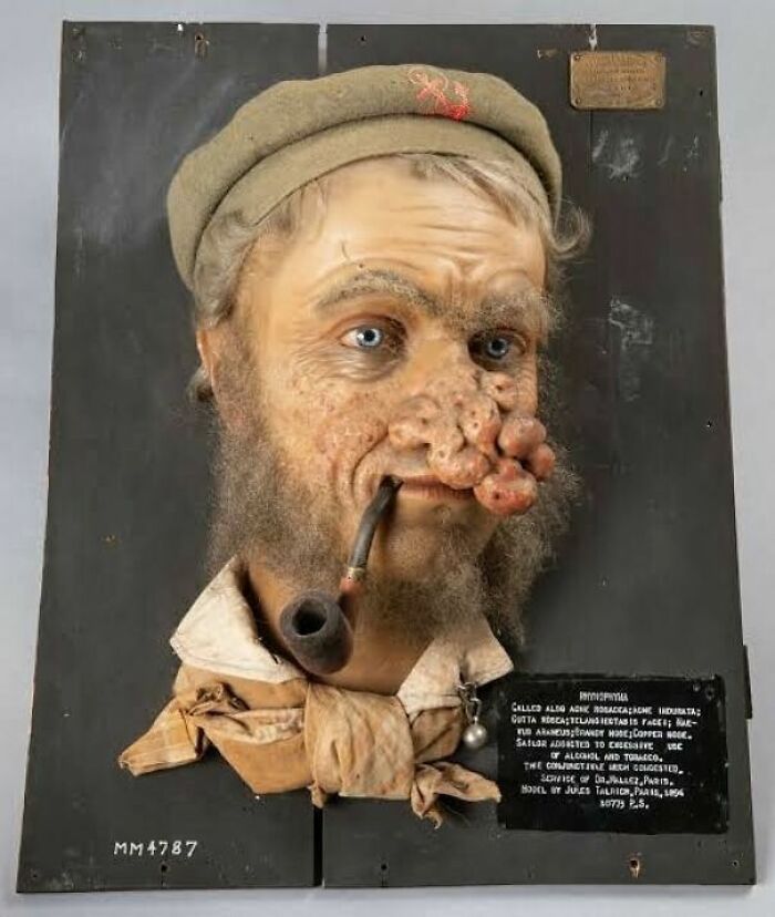 Wax Model Of A French Sailor With Skin Disease Of The Nose, Made In 1894