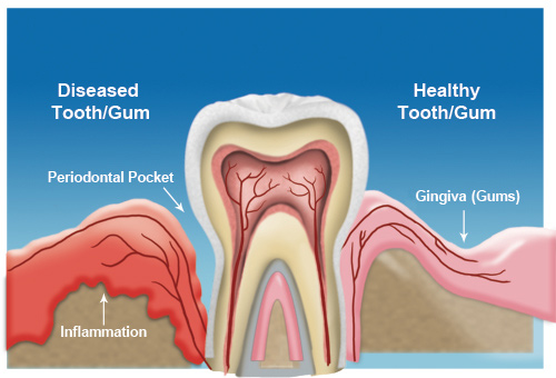 gum-disease3.jpg