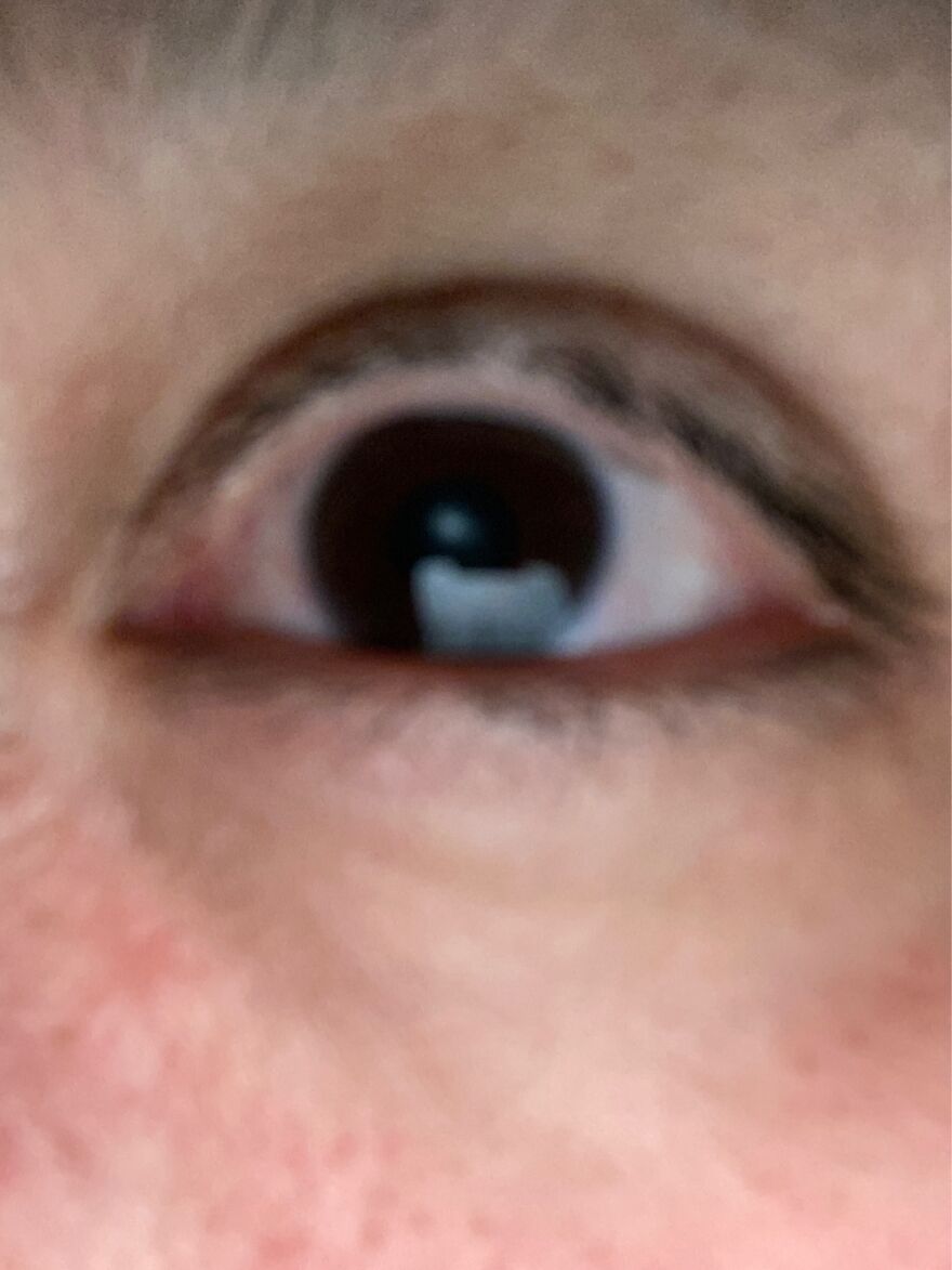 Cannabis Dark Brown Featuring A Cataract