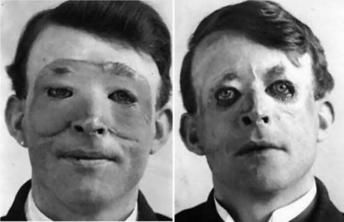 One Of The First People To Undergo Modern Plastic Surgery, Walter Yeo Was Operated On By The ‘Father Of Cosmetic Surgery’ Harold Gillies In 1917