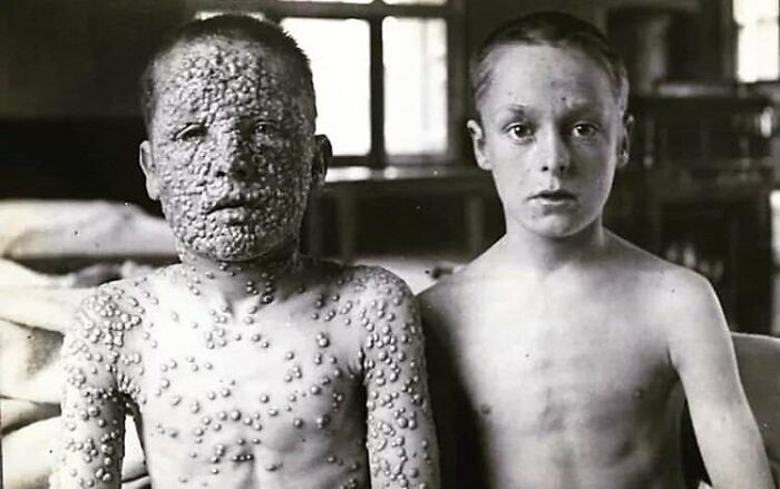 Unvaccinated And Vaccinated Boys With Small Pox