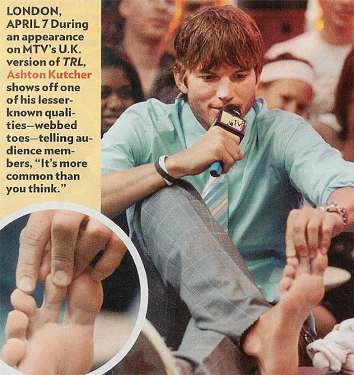 Ashton Kutcher Has Webbed Toes