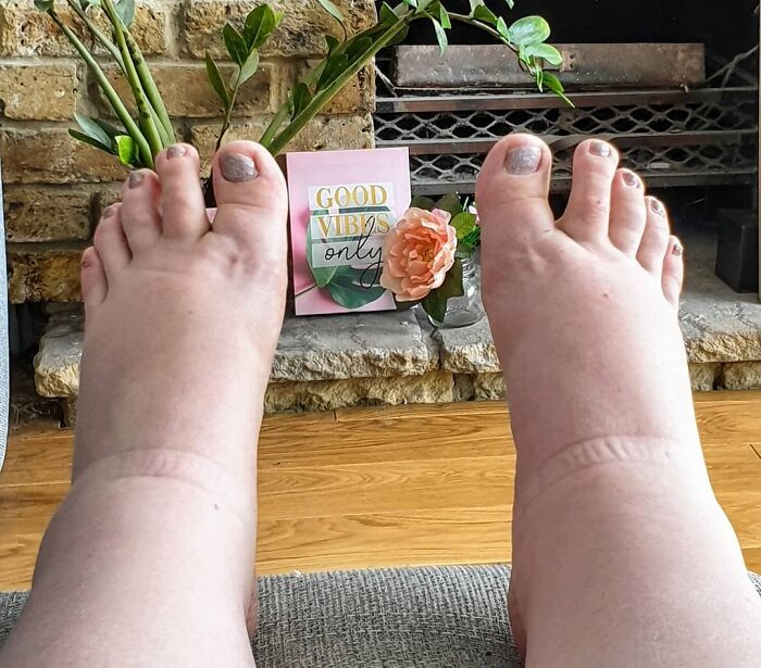 3rd Trimester Swollen Feet. This Is What My Feet Look Like After 2 Hours Sat With Them Down In The Sun - Swollen And Itchy