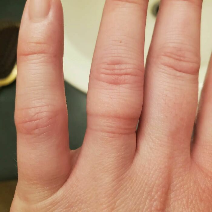 Guys! The Struggle Is Real! 4.5 Weeks To Go, And I Am So Swollen. Been Trying To Get My Wedding Ring Off For A While Now To Give My Swollen Finger A Break! Finally Got It Off