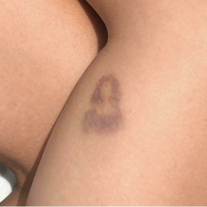 My Friends Bruise Resembles The Mona Lisa