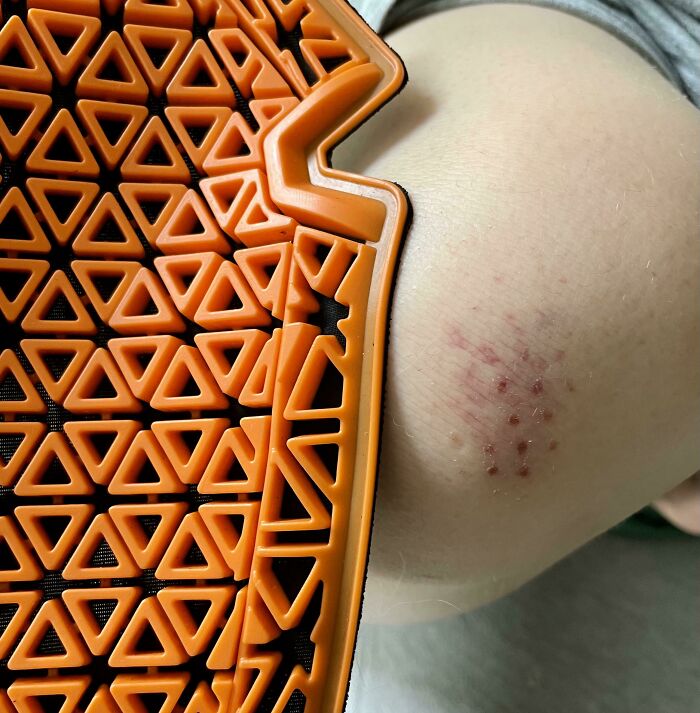 I Was In A Motorcycle Accident And My Gear Did Such A Good Job That My Only Skin Injury Was A Knee Armor Imprint
