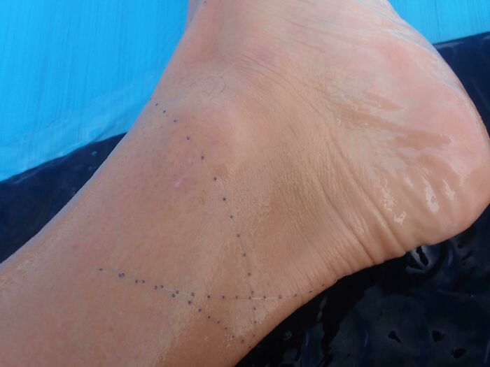 Tentáculo urticante de carabela portuguesa enredado en mi tobillo