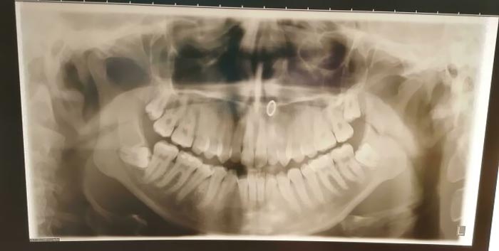 My Wisdom Teeth. No One Wants To Extract Them Because They Could Cut The Alveolar Nerve