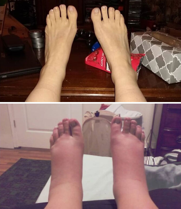 Mis pies ahora (arriba) vs. mis pies cuando estaba embarazada de 8 meses de gemelos (abajo)