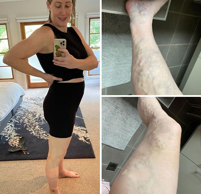 This Lovely Aussie Doctor Knows How Normal (But Unsightly!) Varicose Veins Can Be During Pregnancy. She Is 18 Weeks Pregnant With Twins Here At 39 Years Old
