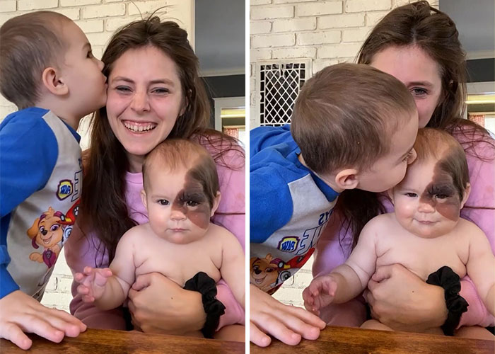 Mom Shares Her Daughter’s Unique Birthmark, Gathering 300k Followers Supporting Their Journey