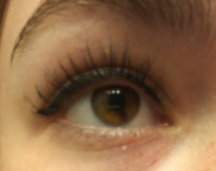 I've Never Really Figured Out My Eye Color, But I Do Have This Sectoral Heterochromia