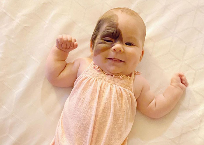 Mom Shares Her Daughter's Unique Birthmark, Gathering 300k Followers Supporting Their Journey | Bored Panda