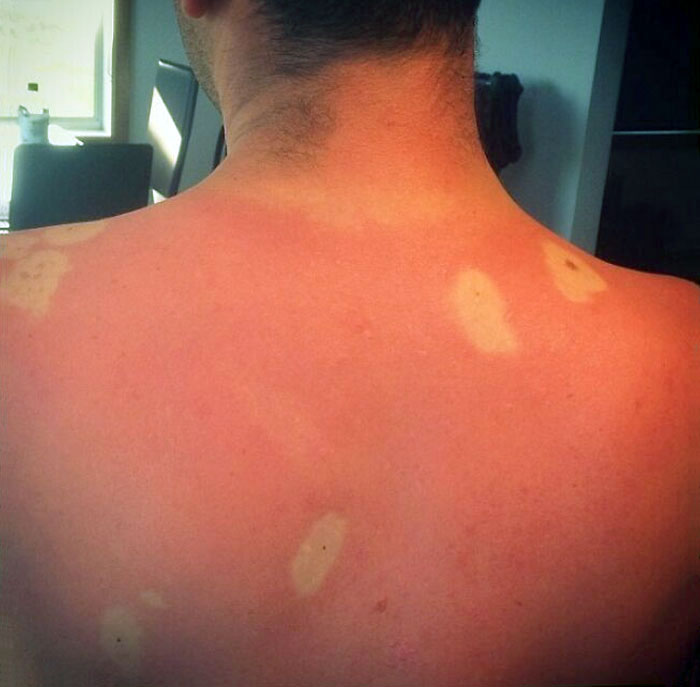 I Probably Should Have Covered His Whole Back In Sunscreen And Not Just His Moles