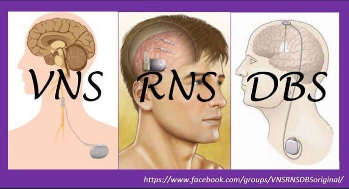 Facebook Support Group Someone Wanted To See The Implanted Devices
