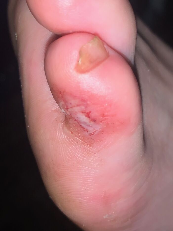 My Completely Destroyed Foot