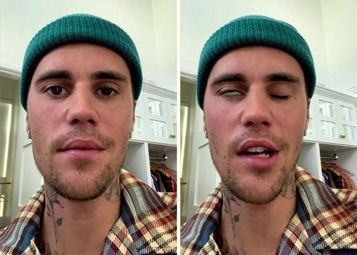 Justin Bieber Has Been Struck By Facial Paralysis, Leading To Ramsay Hunt Syndrome Diagnosis And Cancellation Of Shows Justin Bieber Has Been Struck By Facial Paralysis, Leading To Ramsay Hunt Syndrome Diagnosis And Cancellation Of Shows