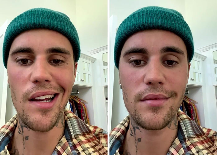 Justin Bieber reveals he suffers from Ramsay Hunt Syndrome, which causes facial paralysis