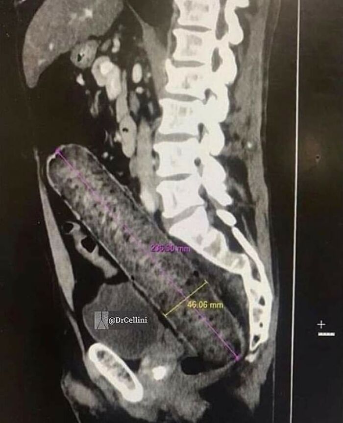 Ct Scan Shows A 10 Inch Sausage Within Rectum