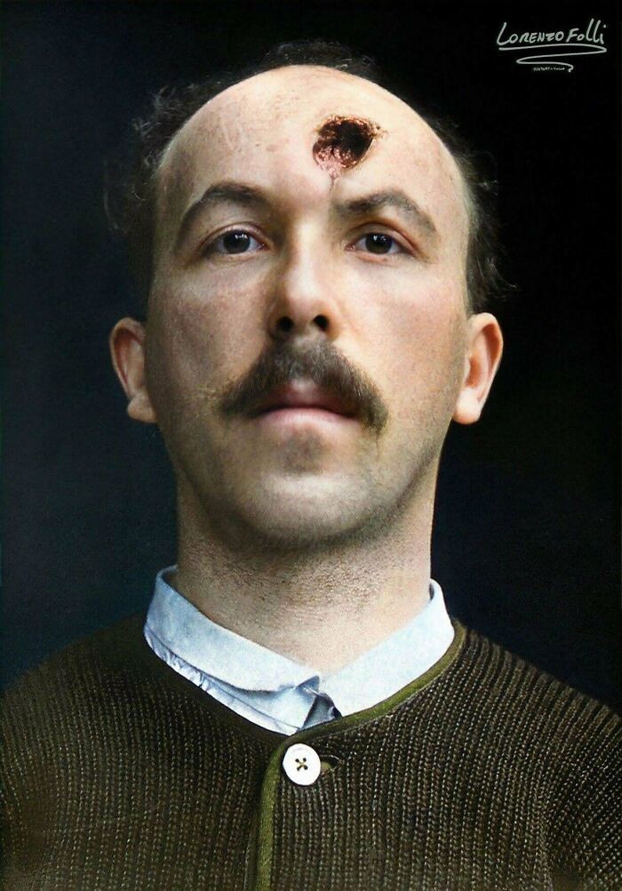 Cranio-Facial Injury: A French Soldier With A Wounded Forehead, Before Plastic Surgery. Photograph, 1915.