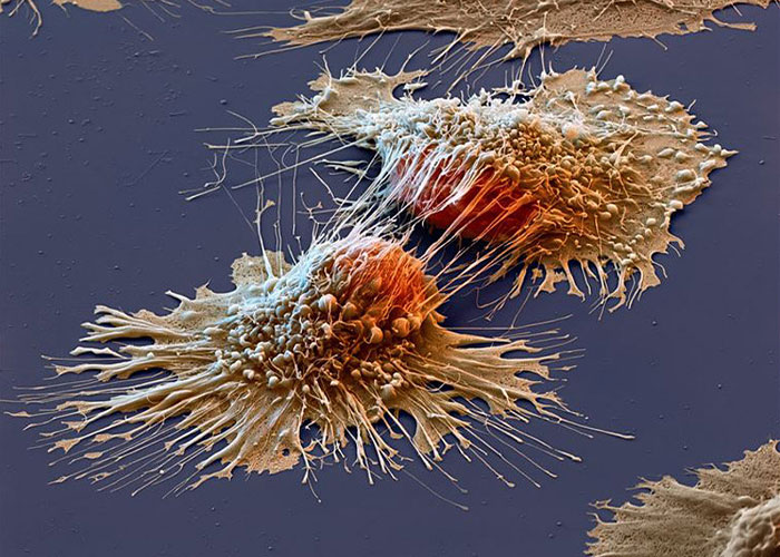 Unexpected Breakthrough In Cancer Drug Trial As All Patients Are Considered In Remission