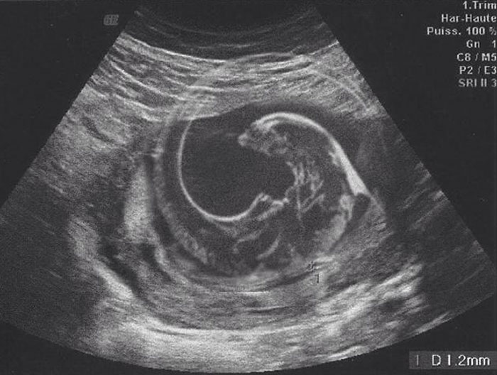 When My Wife Had An Ultrasound For Our First Child I Took A Photo Of The Print Out So She Could Send To Friends And Family. Instead I Sent Her This Xenomorph Image