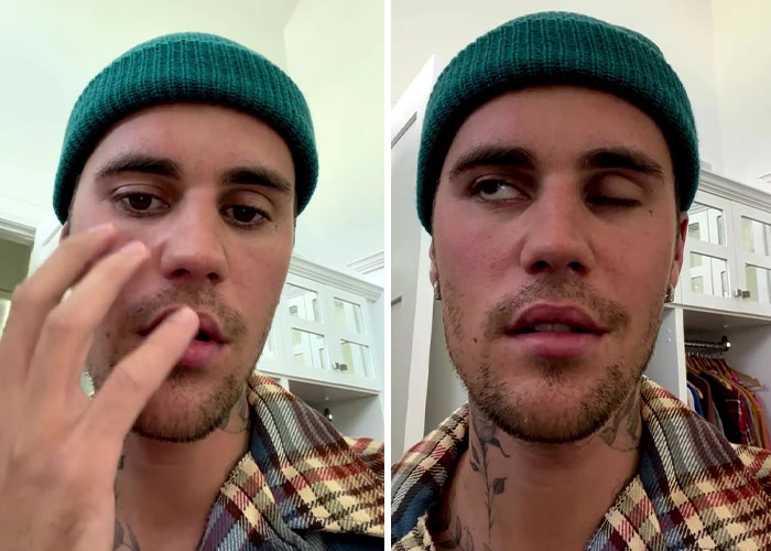 Justin Bieber Has Been Struck By Facial Paralysis, Leading To Ramsay Hunt Syndrome Diagnosis And Cancellation Of Shows