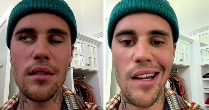 Justin Bieber Has Been Struck By Facial Paralysis, Leading To Ramsay Hunt Syndrome Diagnosis And Cancellation Of Shows