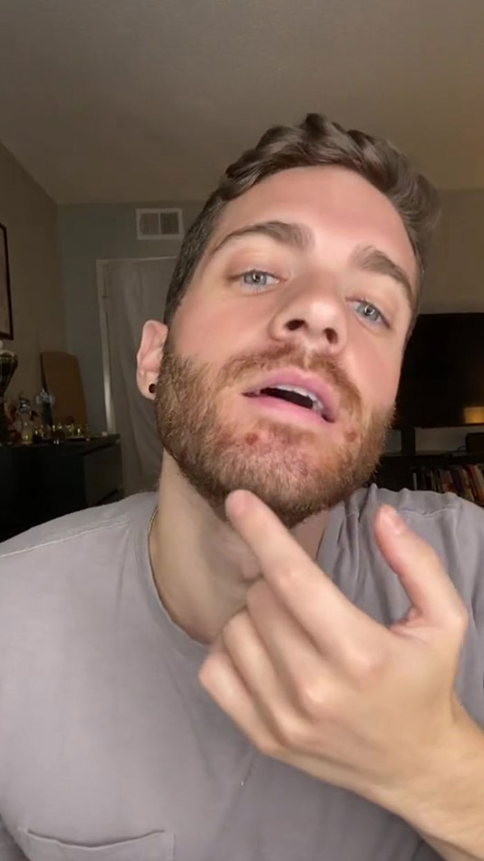 Monkeypox Is Starting To Spread More Widely And This Guy Shares What You Can Expect As He Went Through It Himself Monkeypox Is Starting To Spread More Widely And This Guy Shares What You Can Expect As He Went Through It Himself