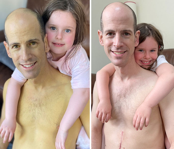 Dad Saved By Liver Transplant Shares Pictures Taken Before And After, Showing His Remarkable Recovery Dad Saved By Liver Transplant Shares Pictures Taken Before And After, Showing His Remarkable Recovery