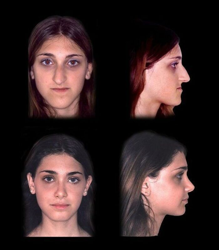 The Difference After Jaw Surgery And Rhinoplasty Made On This Woman