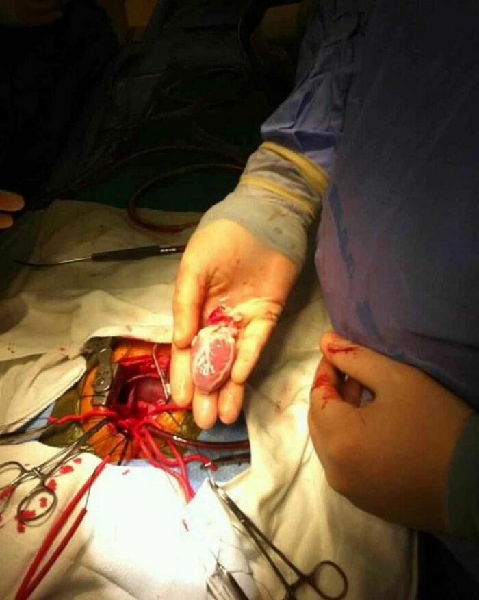 Pediatric Heart Transplant Procedure!