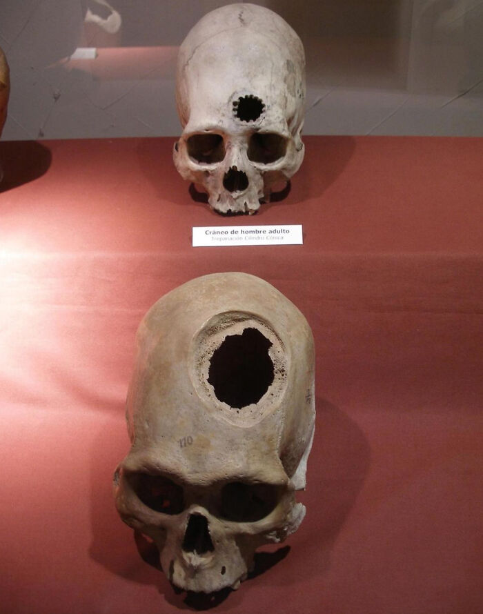 Restos arqueológicos de pacientes tras una cirugía cerebral realizada por doctores incas en el siglo XV