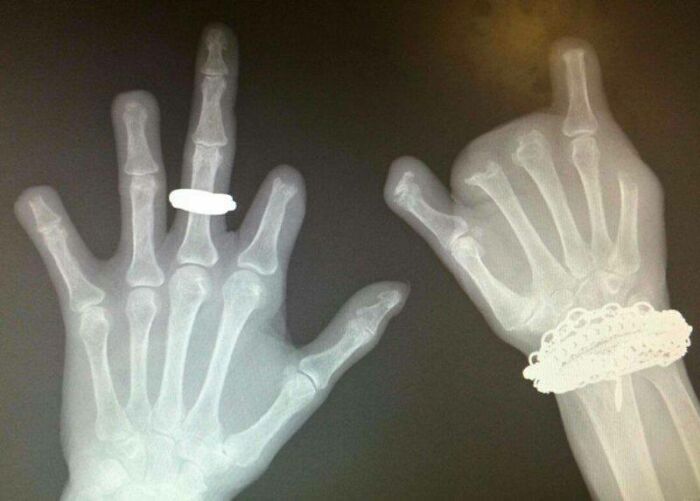 X-Ray Of A Patient Who Had A Long History Of Chewing And Gnawing Their Fingers To The Bone
